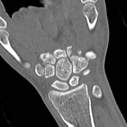 Metacarpal Fractures - CTisus CT Scan