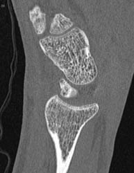 Pin in Scaphoid on High Resolation Bone Imaging - CTisus CT Scan