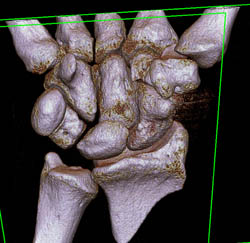 Fusion in Scaphoid in 3D - CTisus CT Scan