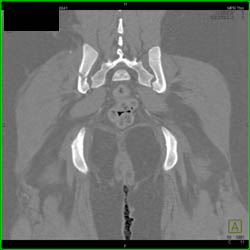 Iliac Fracture With SI Joint Diastasis and Symphysis Diastasis - CTisus CT Scan