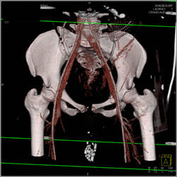 Pregnant Patient With Iliac Fracture and Diastasis of Right SI Joint - CTisus CT Scan