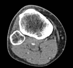 Popliteal Arterial Mediolysis - CTisus CT Scan