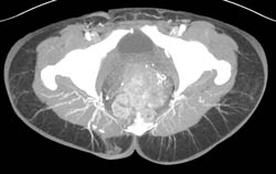 Gluteal Artery Mapping for Reconstructive Surgery in Multiple Perspectives - CTisus CT Scan