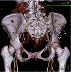 Distal Radius Fracture Through Articular Surface - CTisus CT Scan