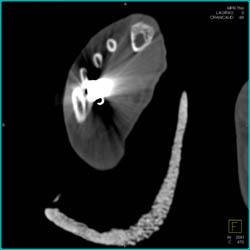 GSW Toe With Fracture and Soft Tissue Injury - CTisus CT Scan