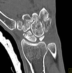 Scaphoid Fracture - CTisus CT Scan