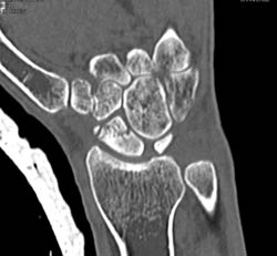 Scaphoid Fracture - CTisus CT Scan