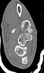 Scaphoid Fracture - CTisus CT Scan