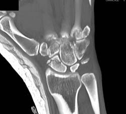 Scaphoid Fracture - CTisus CT Scan