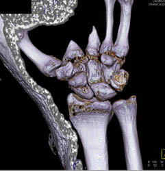 Scaphoid Fracture - CTisus CT Scan