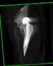 Dislocated Hip Prosthesis - CTisus CT Scan