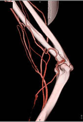 CTA Arm S/P Stabbing - CTisus CT Scan