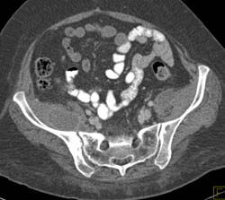 Psoas Abscess With Prior Collapsed and Fused Vertebral Artery - CTisus CT Scan