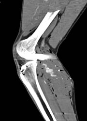 GSW Knee With Bleed From Popliteal Artery - CTisus CT Scan