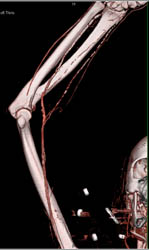 CTA With Vascular Disease in Radial and Ulnar Arteries - CTisus CT Scan