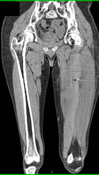 Lymphoma - CTisus CT Scan