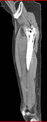 Lymphoma - CTisus CT Scan