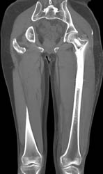 Lymphoma - CTisus CT Scan