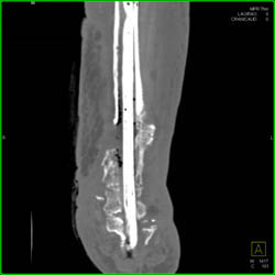 Non-union Post Repair - CTisus CT Scan