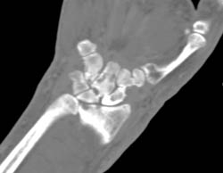 Gout - CTisus CT Scan