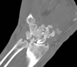 Gout - CTisus CT Scan