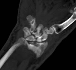 Gout - CTisus CT Scan