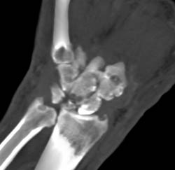 Gout - CTisus CT Scan