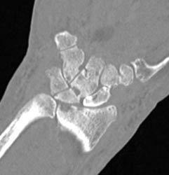 Gout - CTisus CT Scan