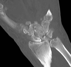 Gout - CTisus CT Scan