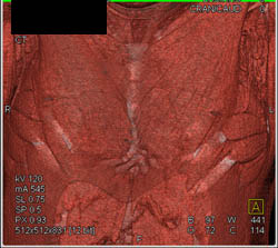 Pectus Deformity - CTisus CT Scan