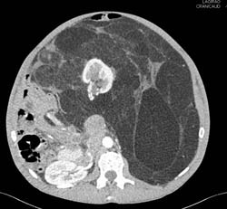 Liposarcoma in Different Renderings - CTisus CT Scan