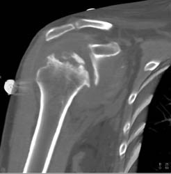 Avascular Necrosis (AVN) Humerus With Fragmentation - CTisus CT Scan