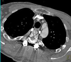 Following Spinal Surgery Pins Extend Into Posterior Mediastinum - CTisus CT Scan