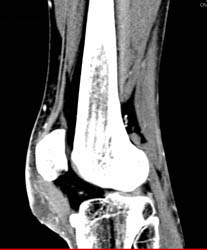 Abscess in Infrapatellar Ligament - CTisus CT Scan