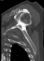 CT With Rotator Cuff Injury and Degenerative Joint Disease (DJD) - CTisus CT Scan