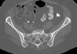 Osteoperosis - CTisus CT Scan