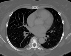 Osteoporosis- Incredible Case! - CTisus CT Scan