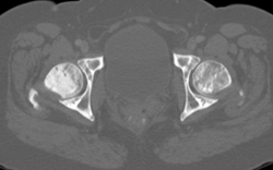 Osteoporosis- Incredible Case! - CTisus CT Scan