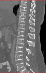 Osteoporosis- Incredible Case! - CTisus CT Scan