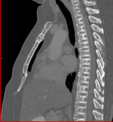 Osteoporosis- Incredible Case! - CTisus CT Scan