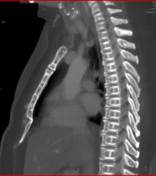 Osteoporosis- Incredible Case! - CTisus CT Scan