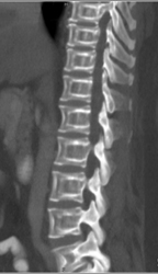 Osteoporosis- Incredible Case! - CTisus CT Scan