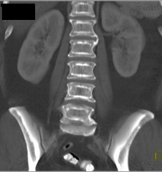 Osteoporosis- Incredible Case! - CTisus CT Scan