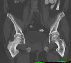 Osteoporosis- Incredible Case! - CTisus CT Scan