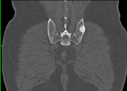 Unusual Case of Solitary Blastic Osteosarcoma - CTisus CT Scan