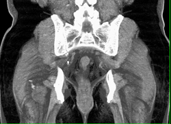 Unusual Case of Solitary Blastic Osteosarcoma - CTisus CT Scan