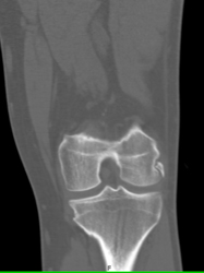 Old Avulsion Injury - CTisus CT Scan