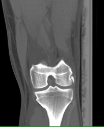 Old Avulsion Injury - CTisus CT Scan