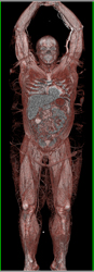 Whole Body CTA of Trauma Study - CTisus CT Scan