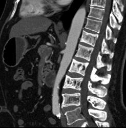 Blastic Metastases - CTisus CT Scan